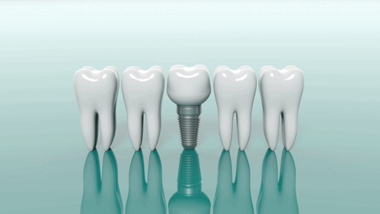 DO I NEED A FULL MOUTH DENTAL IMPLANT CONSULTATION?